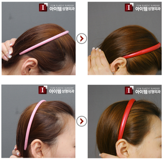 Illustration for article titled "Round Head" Plastic Surgery Seems Excessive, Even for South Korea